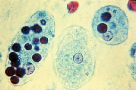 E. histolytica (true pathogen) - identification of red blood cells