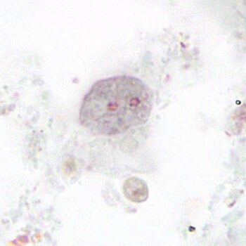Dientamoeba-fragilis-Parasite-stain